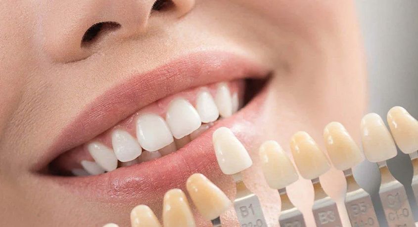 Невероятное предложение от стоматологии «Стар Дент»! Установка керамических виниров под ключ со скидкой 60%.